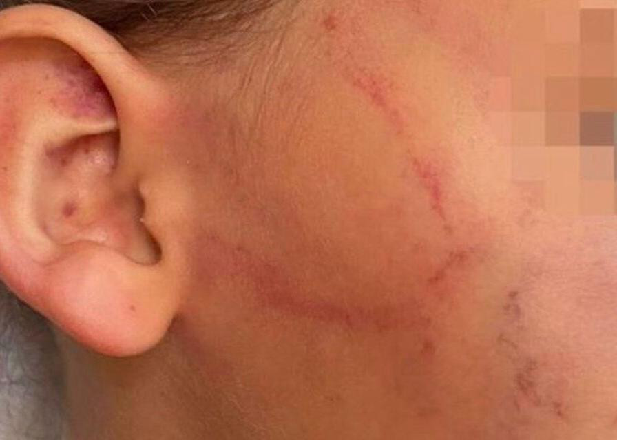 Mãe morde filha de quatro anos no rosto depois que menina urinou na roupa